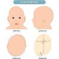 Flat head plagiocephaly